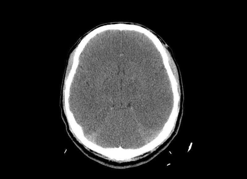 File:Cerebral edema (Radiopaedia 82519-96661 Axial non-contrast 31).jpg