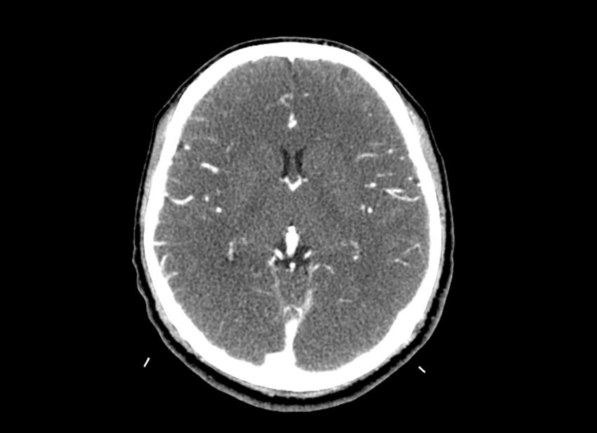 Cerebral edema (Radiopaedia 82519-96661 B 30).jpg