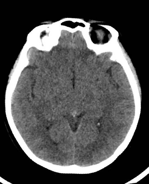 File:Cerebral edema due to severe hyponatremia (Radiopaedia 89826-106938 Axial non-contrast 48).jpg