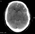 Cerebral hemorrhagic contusion with subdural and subarachnoid hemorrhage (Radiopaedia 10680-11146 Axial non-contrast 11).jpg