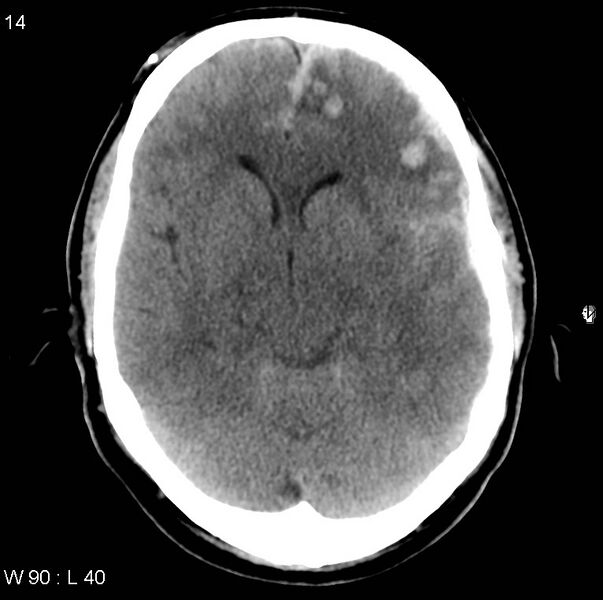 File:Cerebral hemorrhagic contusion with subdural and subarachnoid hemorrhage (Radiopaedia 10680-11146 Axial non-contrast 11).jpg