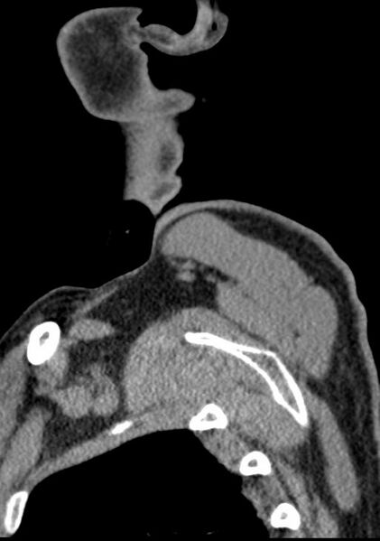File:Cerebral hemorrhagic contusions and cervical spine fractures (Radiopaedia 32865-33841 G 4).jpg