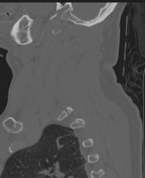 File:Cerebral hemorrhagic contusions and cervical spine fractures (Radiopaedia 32865-33841 Sagittal bone window 78).jpg