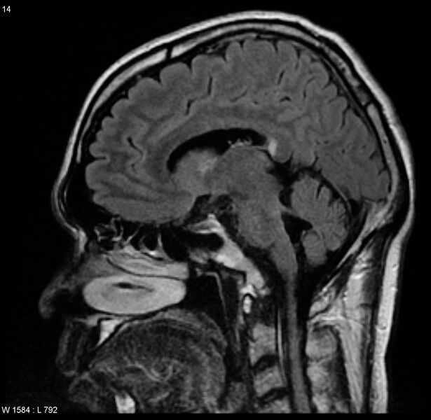 File:Cerebral vasculitis (Radiopaedia 5131-6923 Sagittal FLAIR 4).jpg