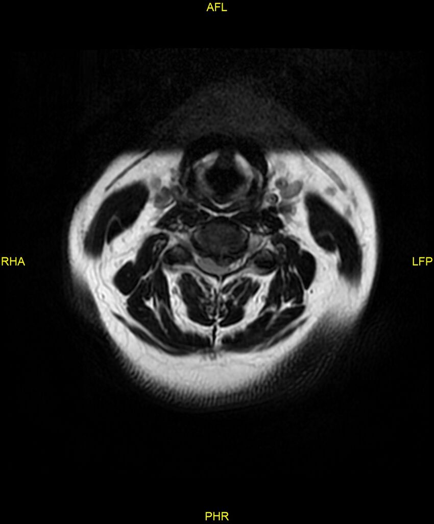 Cervical disc protrusion (Radiopaedia 87147-103415 Axial T2 9).jpg