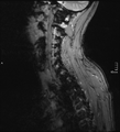 Cervical dural CSF leak on MRI and CT treated by blood patch (Radiopaedia 49748-54995 D 1).png