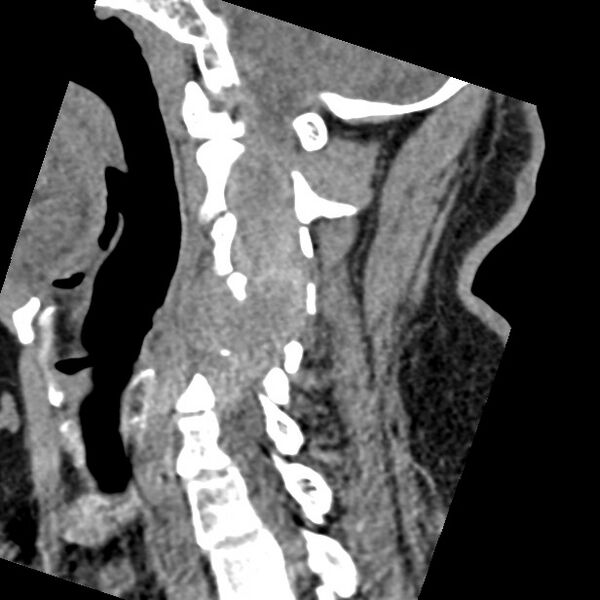 File:Cervical spinal neurofibroma in a patient with NF1 (Radiopaedia 58344-65464 C 22).jpg