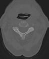 Cervical spine ACDF loosening (Radiopaedia 48998-54071 Axial bone window 22).png