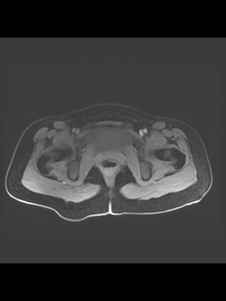 File:Cesarean section scar endometrioma (Radiopaedia 56569-63297 Axial T1 C+ fat sat 3).jpg
