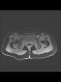 Cesarean section scar endometrioma (Radiopaedia 56569-63297 Axial T1 C+ fat sat 3).jpg