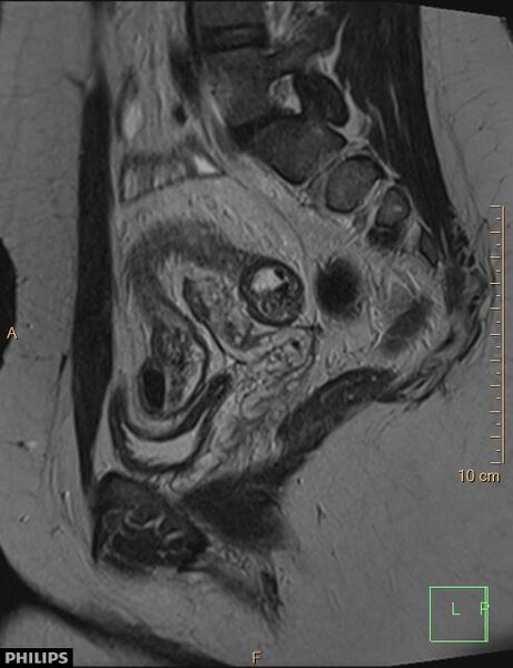 File:Cesarian scar endometriosis (Radiopaedia 68495-78066 Sagittal T2 10).jpg