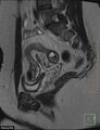 Cesarian scar endometriosis (Radiopaedia 68495-78066 Sagittal T2 10).jpg