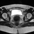Cesarian section scar endometriosis (Radiopaedia 66520-75799 Axial T2 18).jpg