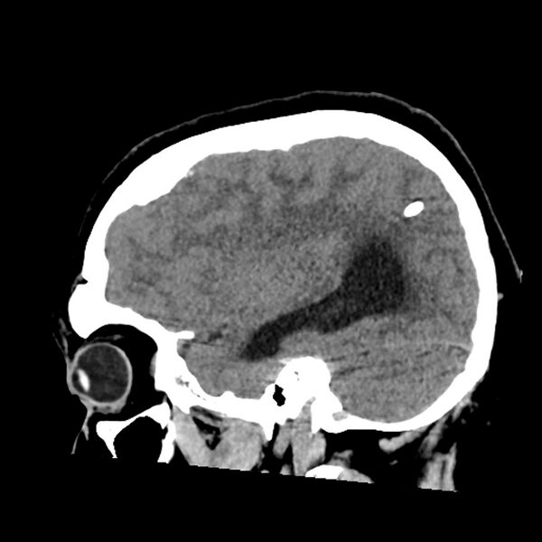 File:Chiasmatic-hypothalamic juvenile pilocytic astrocytoma (Radiopaedia 78533-91237 B 45).jpg