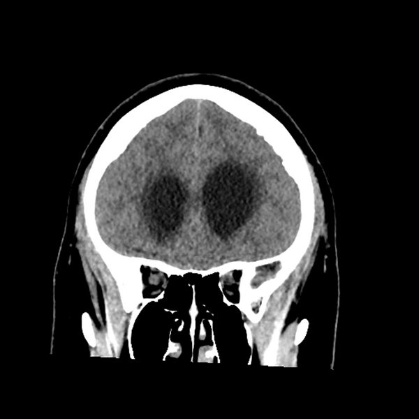 File:Chiasmatic-hypothalamic juvenile pilocytic astrocytoma (Radiopaedia 78533-91237 Coronal non-contrast 22).jpg