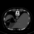 Cholecystitis - CT IVC obstructive choledocholitiasis (Radiopaedia 43966-47479 Axial Biliscopin 25).png