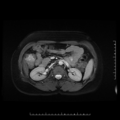 Choledochal cyst with chronic calcific pancreatitis (Radiopaedia 18245-18062 Axial T2 11).png