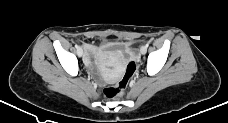 File:Choriocarcinoma liver metastases (Radiopaedia 74768-85766 A 178).jpg