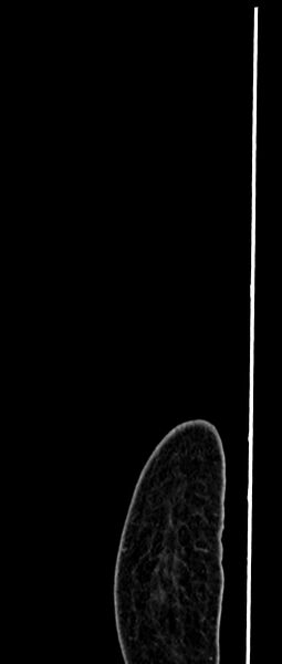 File:Choriocarcinoma liver metastases (Radiopaedia 74768-85766 C 16).jpg