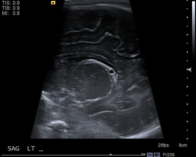 File:Choroid plexus cyst (Radiopaedia 27209).jpg