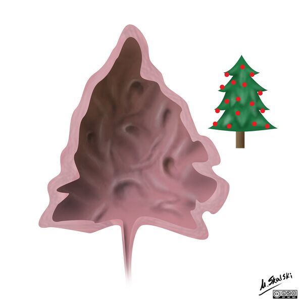 File:Christmas tree neurogenic bladder (Radiopaedia 41884-44887 A 1).jpg