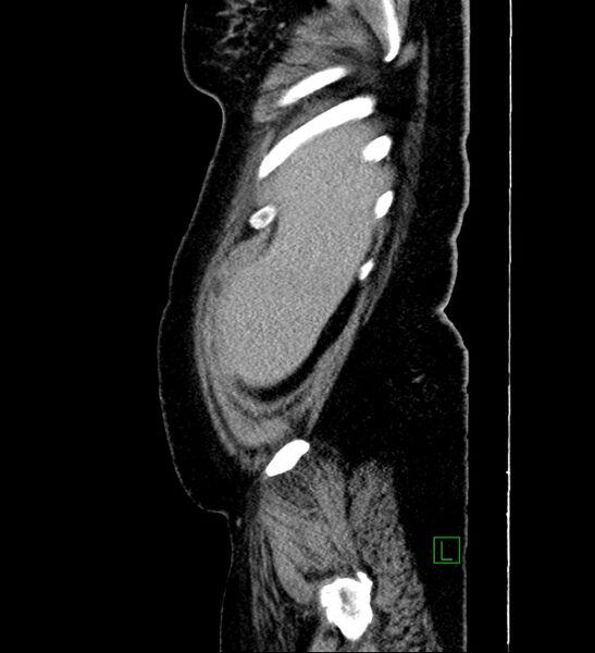 File:Chromophobe renal cell carcinoma (Radiopaedia 84239-99519 G 105).jpg