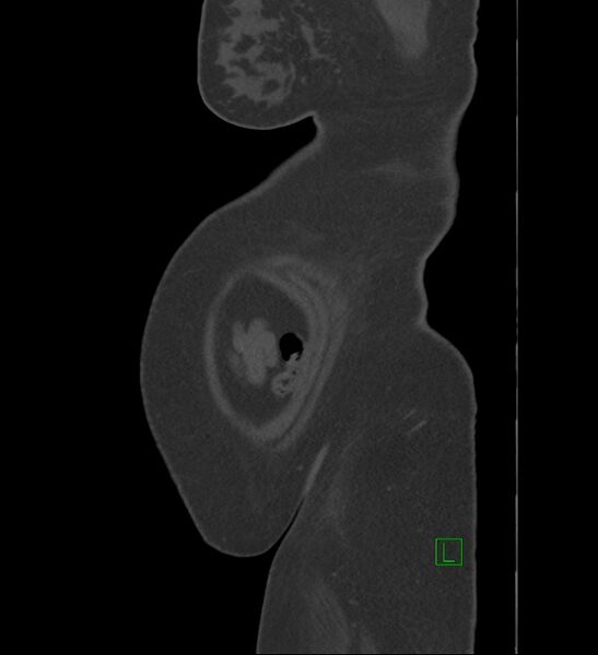 File:Chromophobe renal cell carcinoma (Radiopaedia 84239-99519 Sagittal bone window 1).jpg