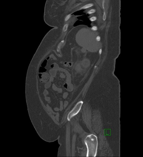File:Chromophobe renal cell carcinoma (Radiopaedia 84239-99519 Sagittal bone window 16).jpg