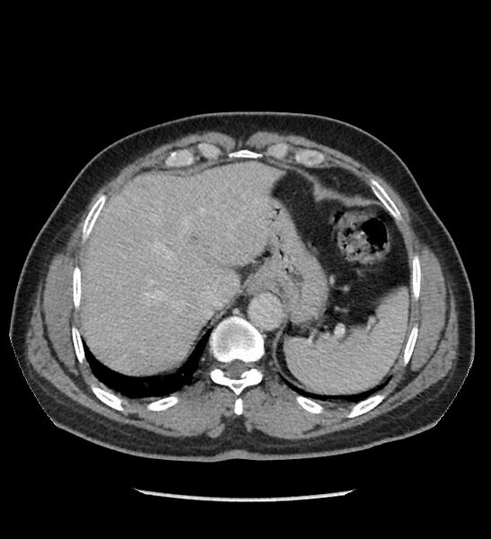 File:Chromophobe renal cell carcinoma (Radiopaedia 86879-103083 C 21).jpg
