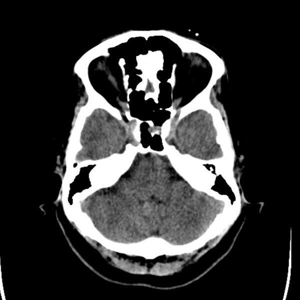File:Chronic bilateral occipital lobe infarcts (Radiopaedia 31276-31996 Axial non-contrast 10).jpg
