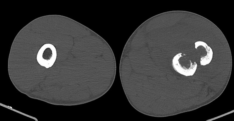 File:Chronic osteomyelitis (with sequestrum) (Radiopaedia 74813-85822 Axial non-contrast 85).jpg