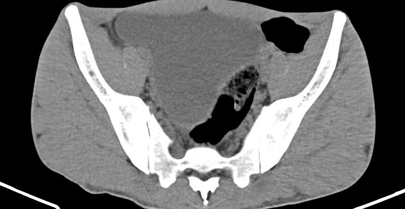 File:Chronic osteomyelitis (with sequestrum) (Radiopaedia 74813-85822 D 15).jpg