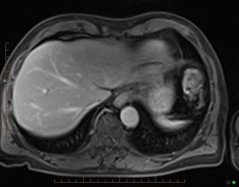File:Chronic pancreatitis (Radiopaedia 17014-16716 Axial T1 C+ fat sat 4).jpg
