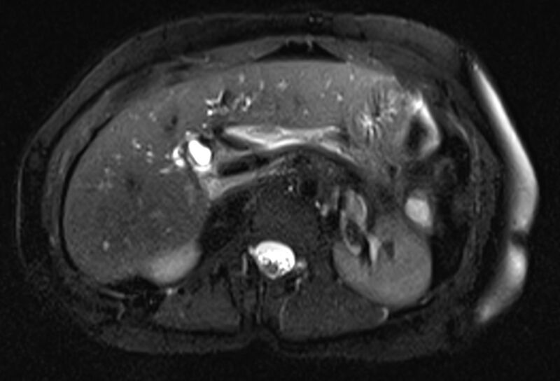 File:Chronic pancreatitis - pancreatic duct calculi (Radiopaedia 71818-82250 Axial T2 fat sat 23).jpg