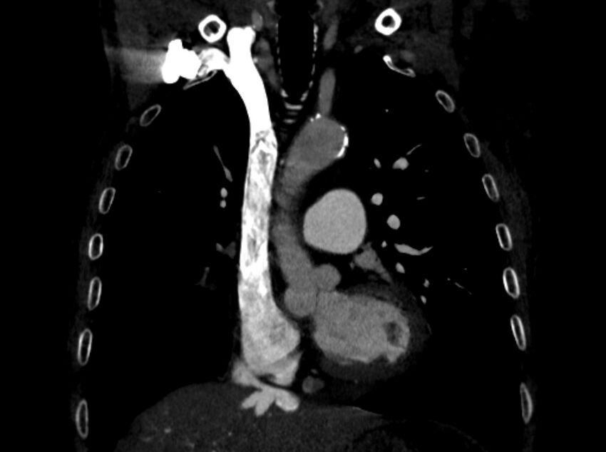 Chronic pulmonary embolism (Radiopaedia 91241-108843 A 42).jpg