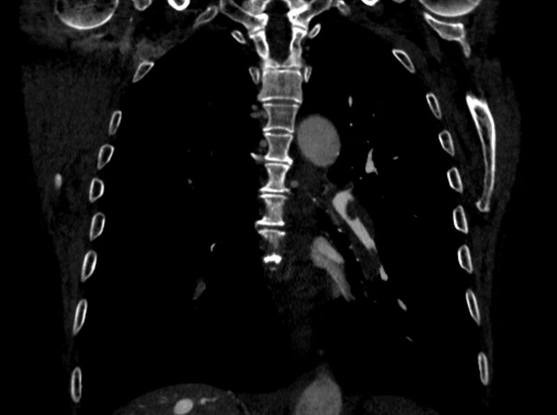 File:Chronic pulmonary embolism (Radiopaedia 91241-108843 A 71).jpg