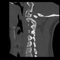 Clay-shoveler fracture (Radiopaedia 22568-22590 Sagittal bone window 31).jpg