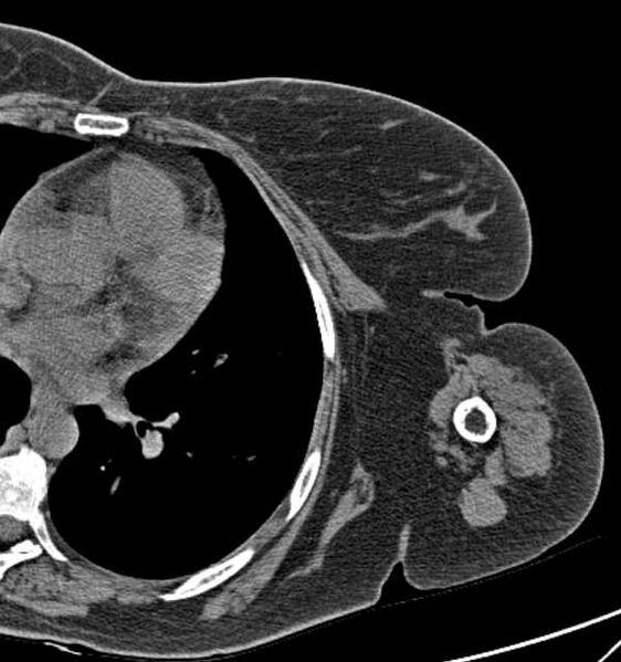 File:Clear cell chondrosarcoma - humerus (Radiopaedia 63104-71612 Axial non-contrast 93).jpg