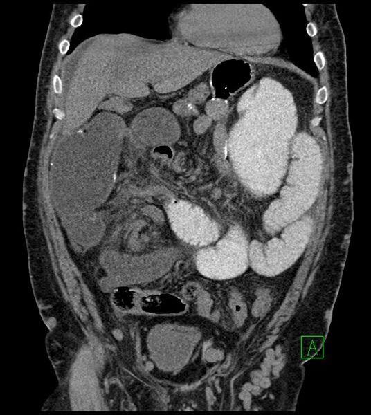 File:Closed-loop small bowel obstruction-internal hernia (Radiopaedia 78439-91096 Coronal non-contrast 38).jpg
