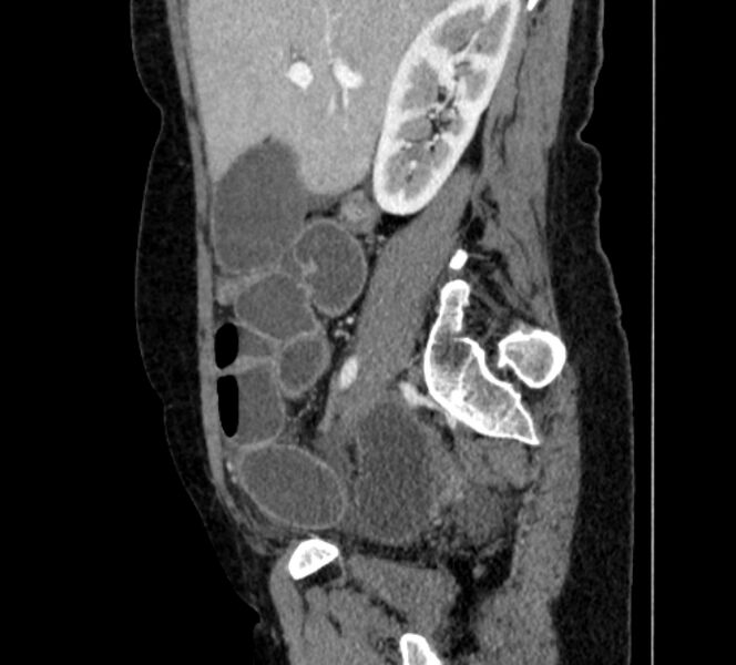 File:Closed loop small bowel obstruction (Radiopaedia 71211-81508 C 38).jpg