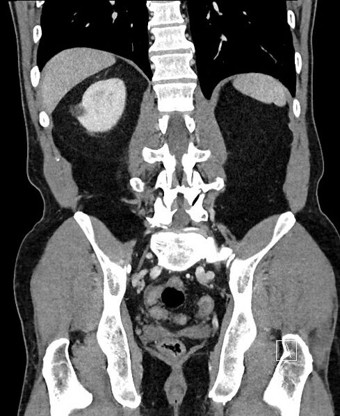File:Closed loop small bowel obstruction - internal hernia (Radiopaedia 57806-64778 A 86).jpg