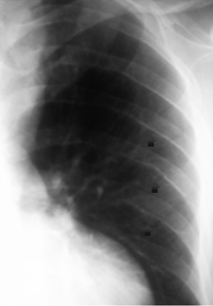 File:Coarctation of aorta (Radiopaedia 12556).PNG