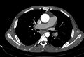 Coarctation of aorta with aortic valve stenosis (Radiopaedia 70463-80574 A 82).jpg