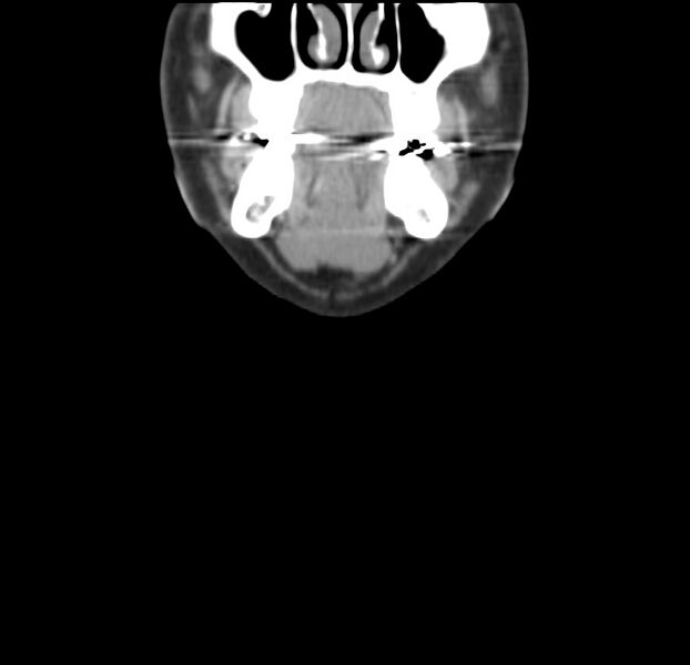 File:Colloid cyst of thyroid (Radiopaedia 22897-22923 Coronal C+ delayed 10).jpg
