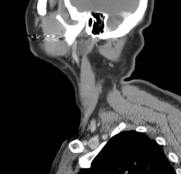 File:Colloid cyst of thyroid (Radiopaedia 22897-22923 Sagittal C+ delayed 48).jpg