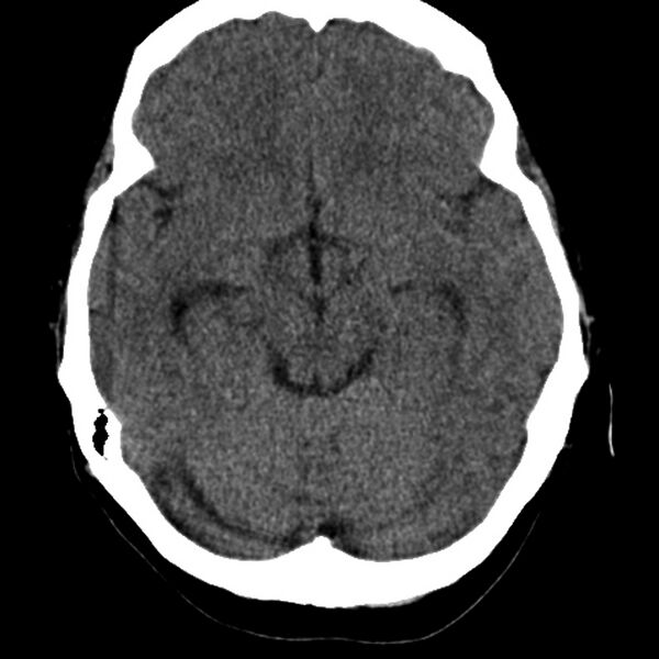 File:Colloid cyst with hydrocephalus (Radiopaedia 9373-10064 Axial non-contrast 8).jpg