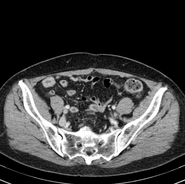 File:Colon carcinoma with hepatic metastases (Radiopaedia 29477-29961 A 90).jpg