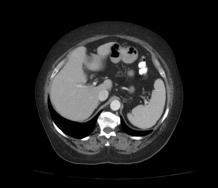 File:Colonic diverticulosis (Radiopaedia 22934-22957 A 17).jpg