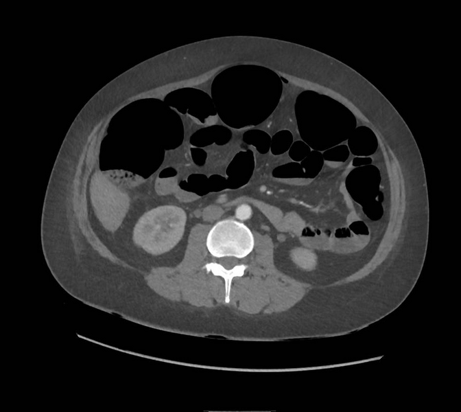 File:Colonic pseudo-obstruction (Radiopaedia 79752-92980 A 93).png