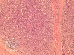 Aggressive digital papillary adenocarcinoma-pathology